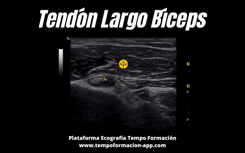 5. Tendon Largo Biceps Ecografia Tempo Formacion.png